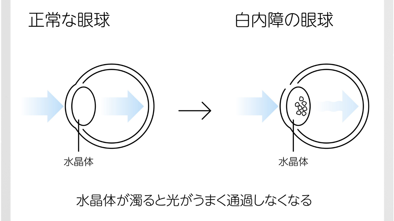 白内障の初期症状