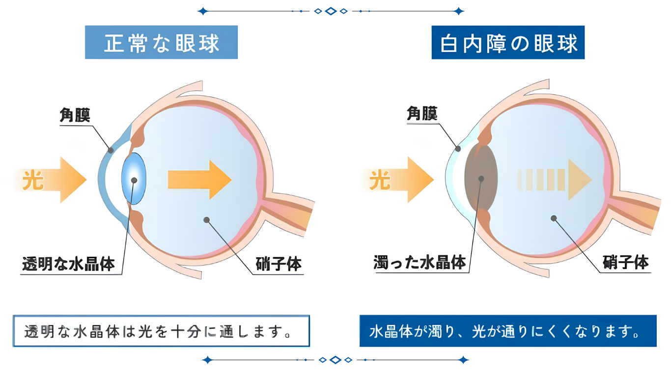 正常な眼球と白内障の眼球における光の通り方の比較イラスト